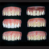 Denture Bases